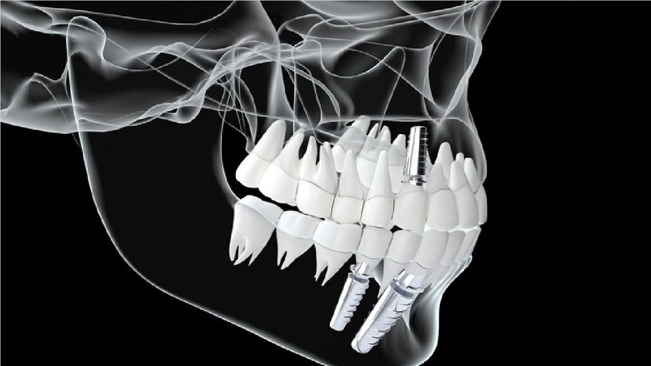What is the Zygoma Implant?