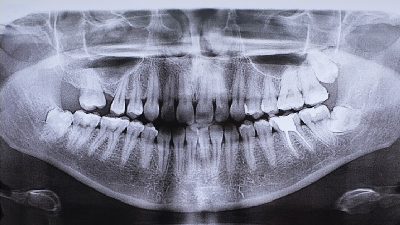 What is the Zygoma Implant?