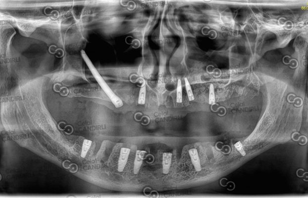 What Is the Zygoma Bone? Zygomatic Implant Steps