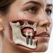 Advanced Tooth Replacement Why Zygomatic Implants Are a Game Changer