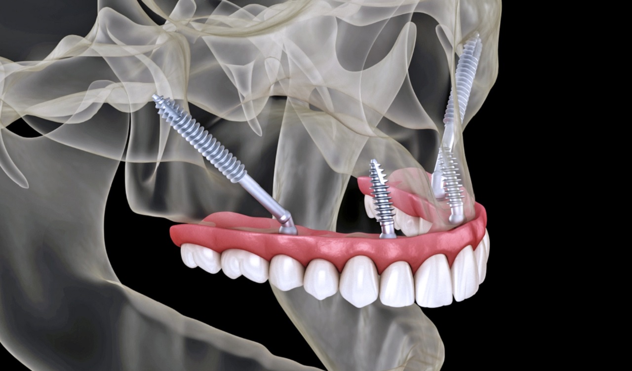 How Much Do Zygomatic Implants Cost in Turkey?