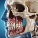 Zygomatic Implants for Severe Bone Loss in the Upper Jaw and Tooth