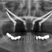 What Are Zygomatic Dental Implants? How to Perform?