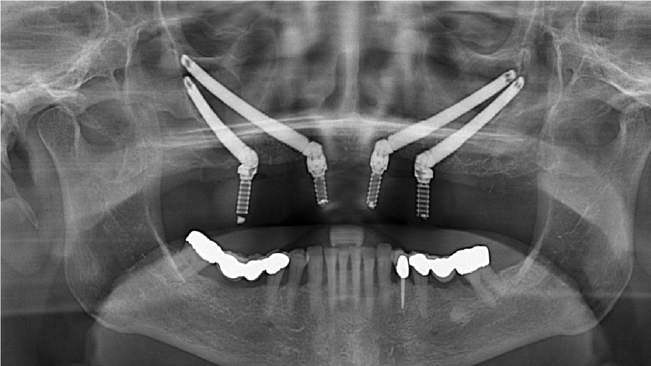 What Are Zygomatic Dental Implants? How to Perform?