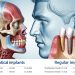 Are Zygomatic Implants More Expensive Than Regular Implants