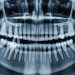 Failed Dental Implants How Zygomatic Implants Give a Second Chance