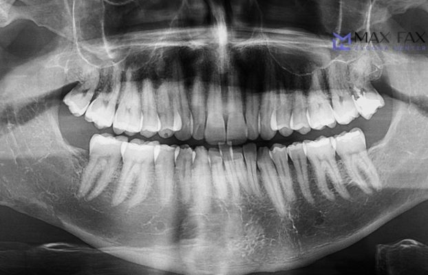 Bone Loss Dental Implant Solutions 2026
