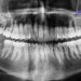 Bone Loss Dental Implant Solutions 2026