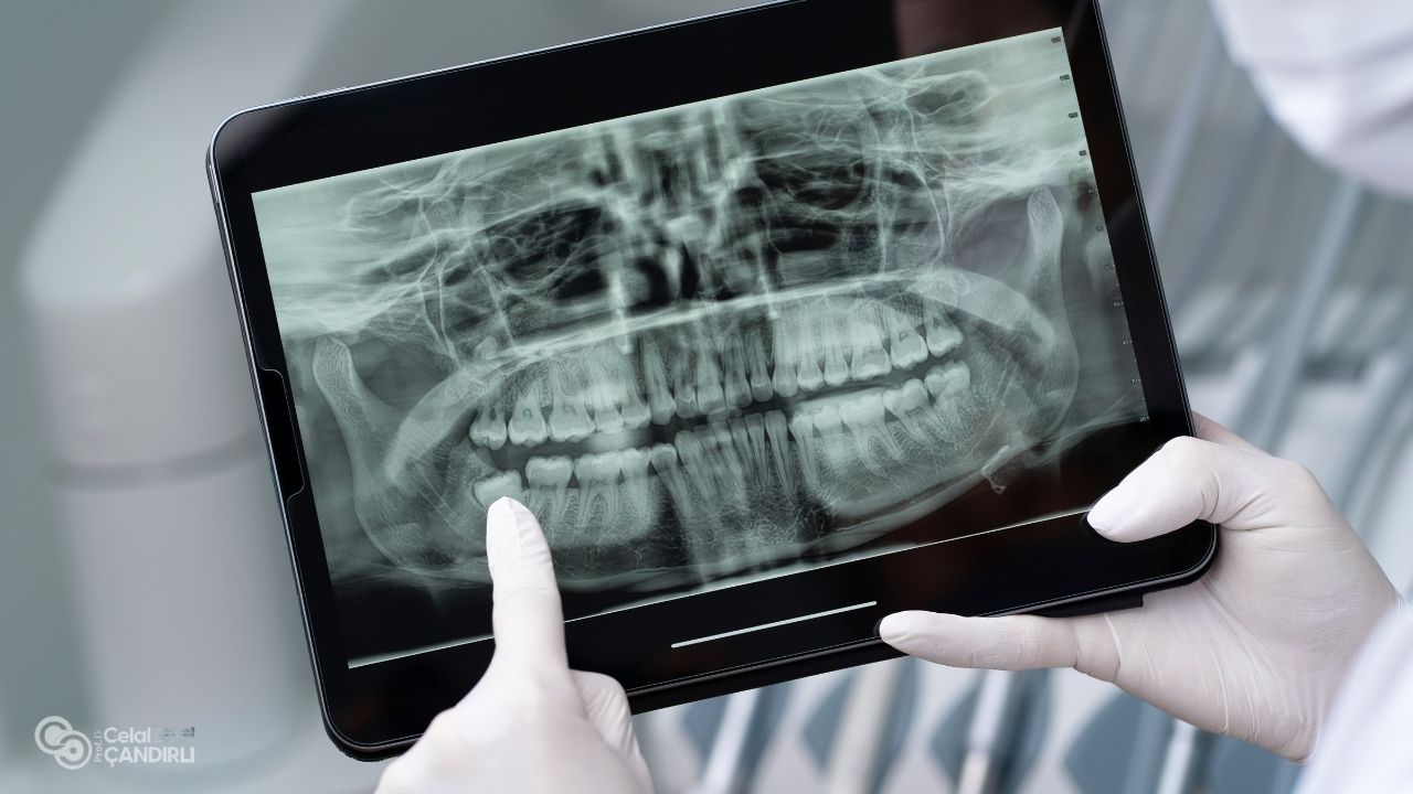 CBCT Scans with Zygomatic Dental Implants