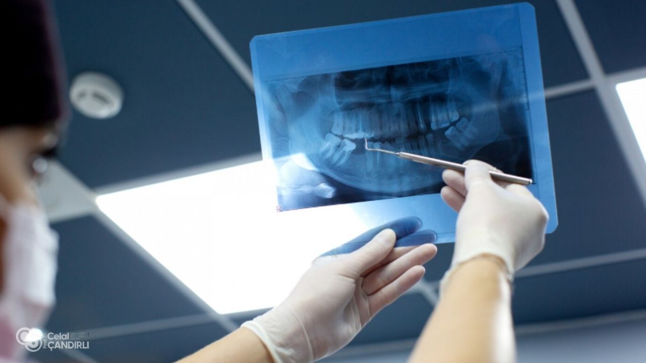 Frequently Asked Questions About CBCT Scans with Zygomatic Dental Implants
