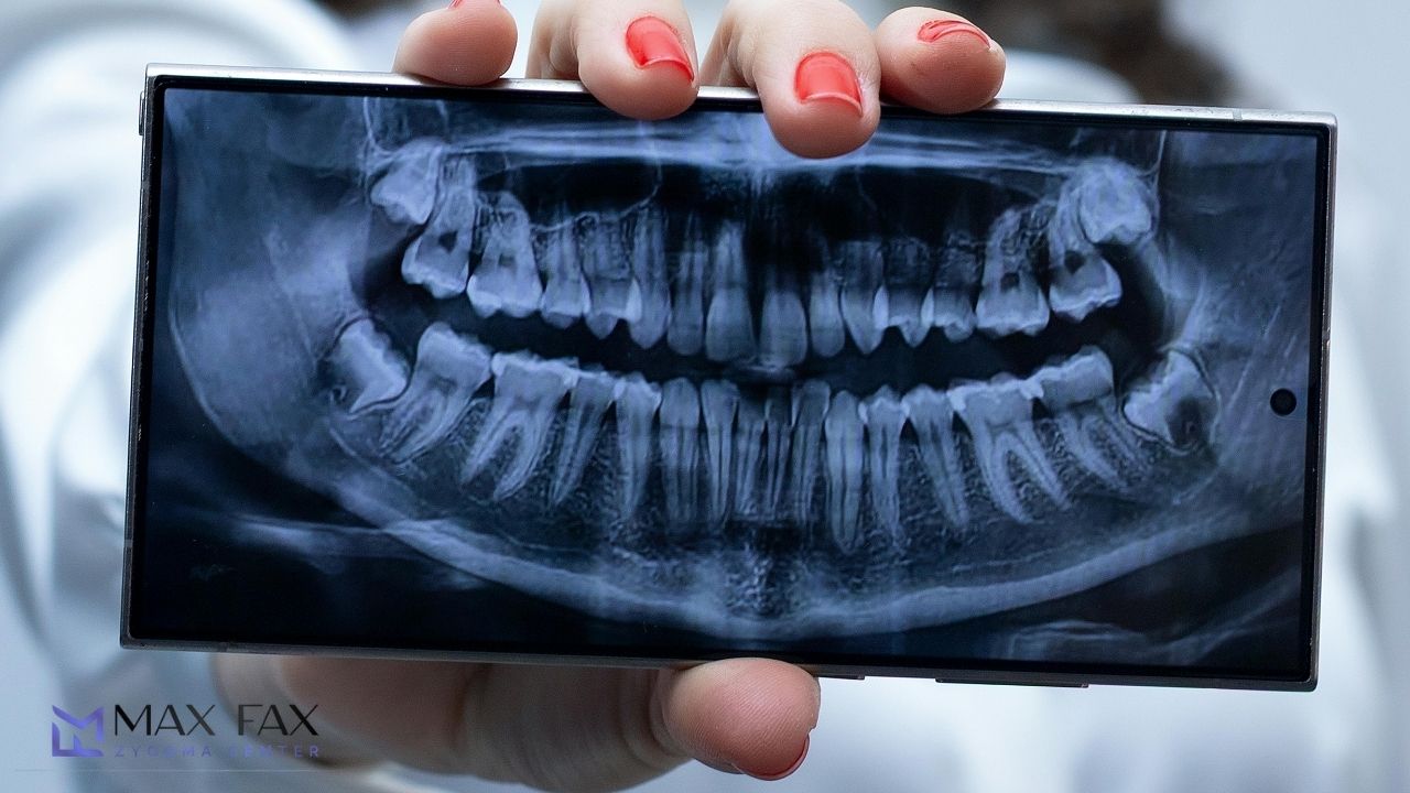 Frequently Asked Questions About Zygomatic Implant Steps