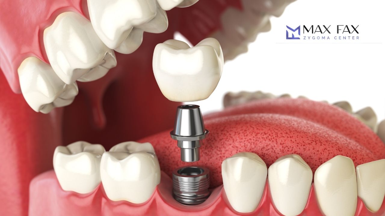 Bone Loss Dental Implant