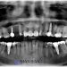 Jawbone Density Effect on Zygomatic Dental Implants