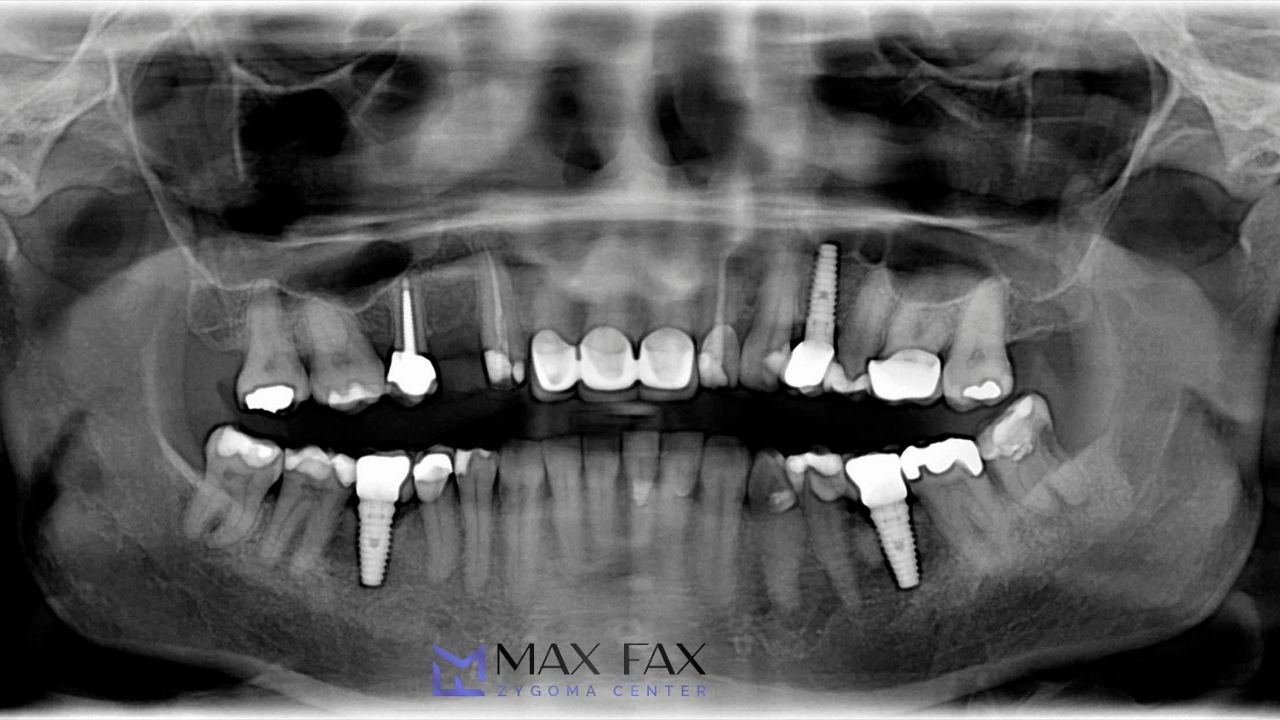 Jawbone Density Effect on Zygomatic Dental Implants