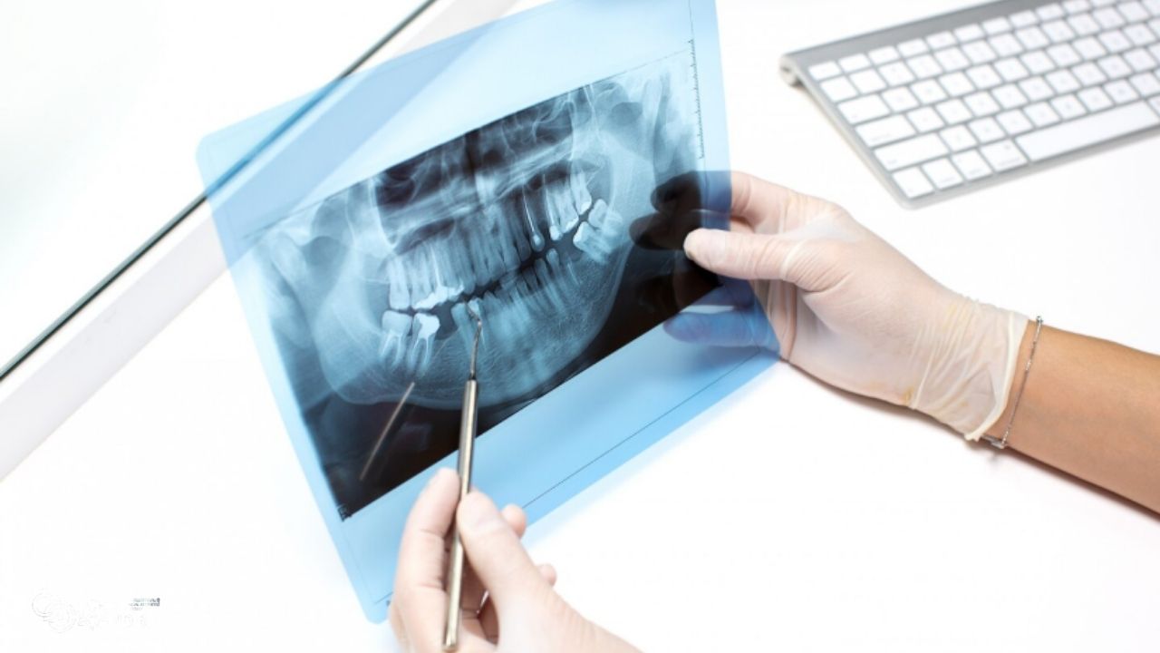 Post-Operative Evaluation Using CBCT Scans