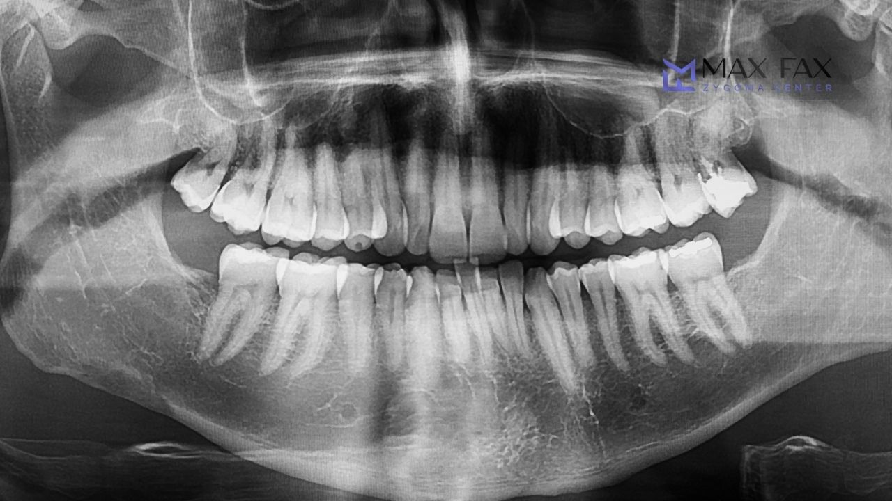 What Is the Zygoma Bone? Zygomatic Implant Steps