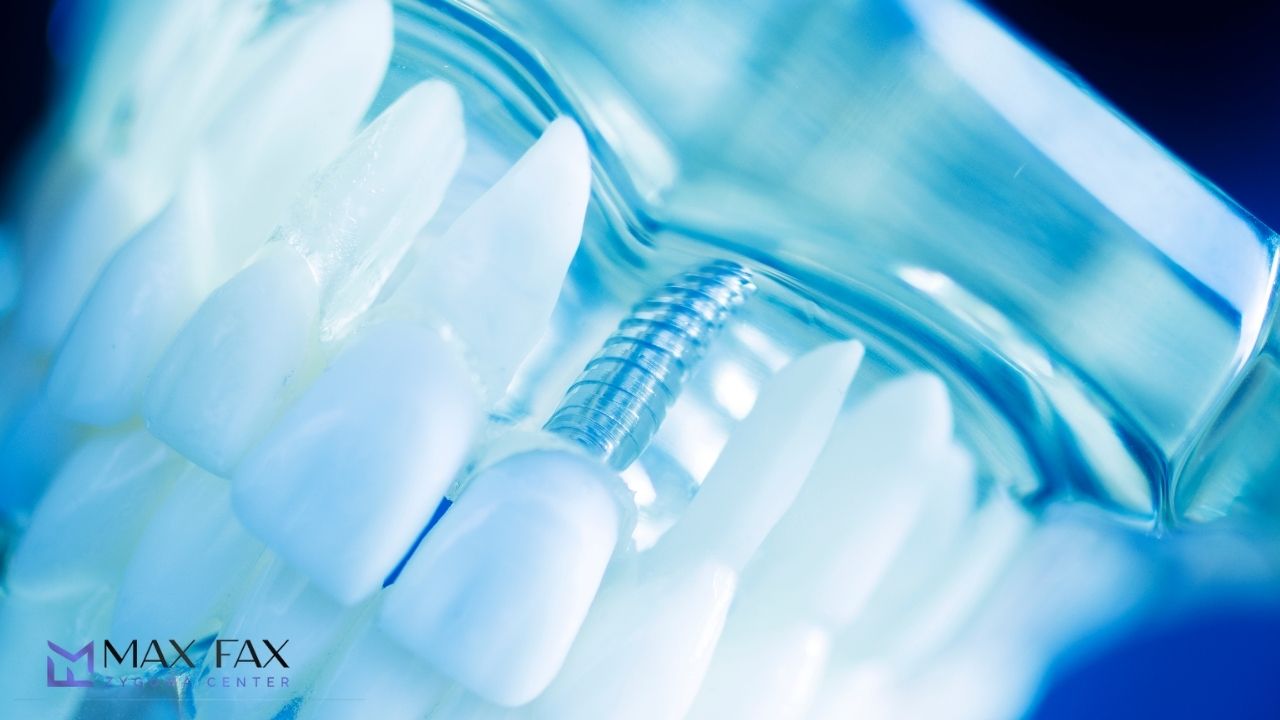 Why You Should Get Zygomatic Implants 2026