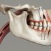 Can a Dental Implant for a Tooth Be Extracted 10 Years Ago?