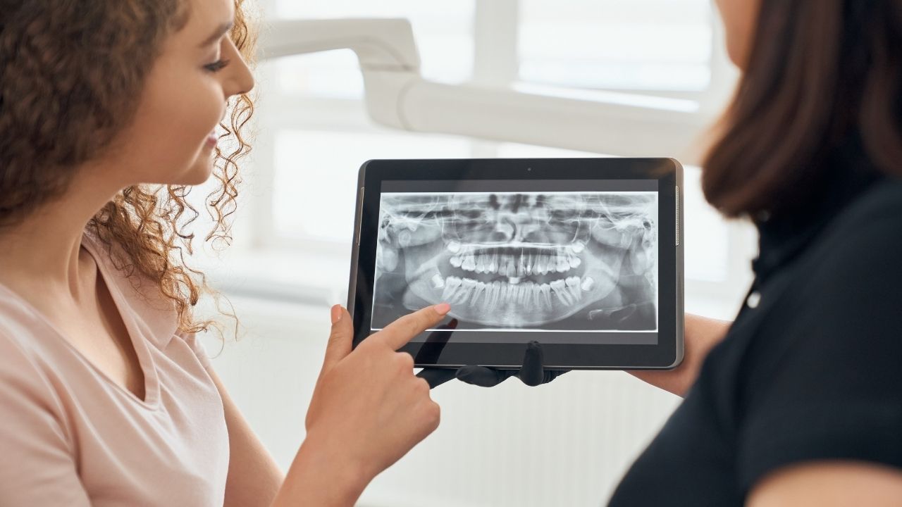 What Are the Advantages of Zygomatic Implants?